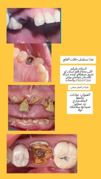 قلع اسنان مجاني • تركيب اسنان مجاني • شارع 40