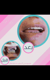 📌 موقعنا: بغداد – المحمودية – حي 17 – مجاور منفذ كرار الطائي
📞 للحجز:
***********
077222263

--- المحموديه مدينتنا الرسمي مطعم مندي دار اليمن فرع المحمودية

#ابتسامتك_حياتك #بلاتينيوم_كلينك #تقويم_الأسنان #فحص_مجاني #ابتسامة_واثقة #بغداد #المحمودية #Orthodontics #PlatinumClinic
