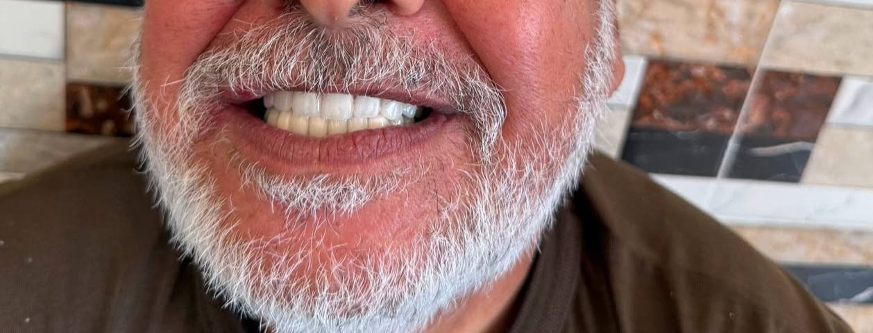 ابتسامتك المثالية صارت أقرب إلك ✨
خصومات خاصة على ابتسامات الأسنان لفترة محدودة 😁🦷
▪️ الزيركون
▪️ الإيماكس
▪️ والسيراميك 
المختبر الابداع السوري  لصناعة الاسنان
و التعويضات السنية وتركيب الأسنان
وبأنسب الاسعار بجميع المحافظات
العراقية 
ملاحظة لدينا كادر يزور المريض للبيت ويتم العمل في المنزل 
للتواصل والحجز. ***********»꧁꧂«***********
