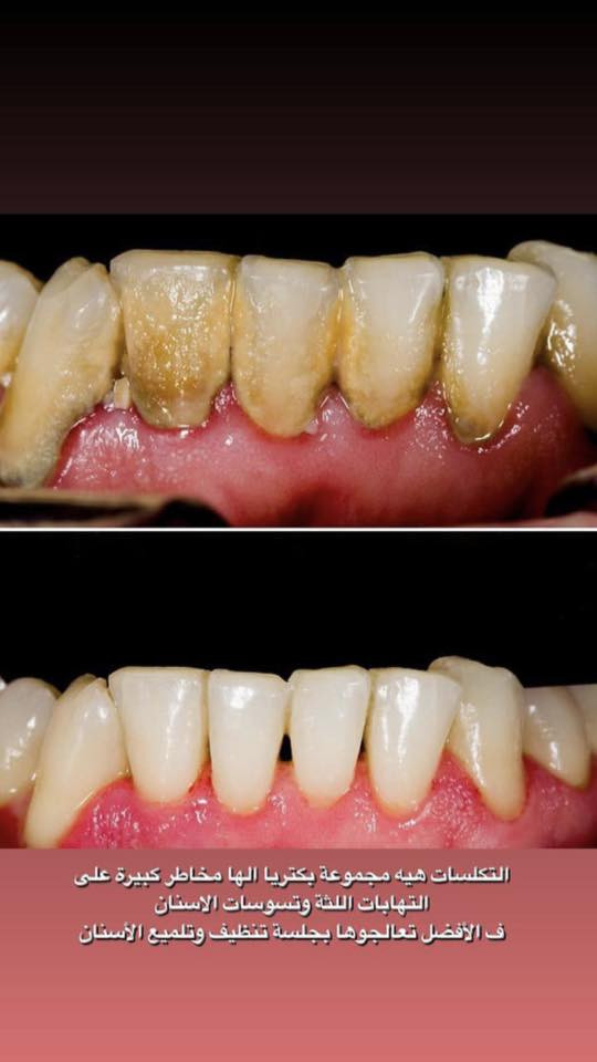 مجانا مجانًا
🛑 تنظيف الاسنان وازاله التكلسات والتصبغات  
 
♦️الوقاية من التهاب اللثة.�♦️الحصول على نَفَس منعش، وذلك بالوقاية من تكون البكتريا المسببة للروائح الكريهة.�♦️الإقلال من تكون التصبغات الخارجية على أسطح الأسنان.

للتواصل والاستفسار اكثر مراسله الصفحه
واتساب ***********
