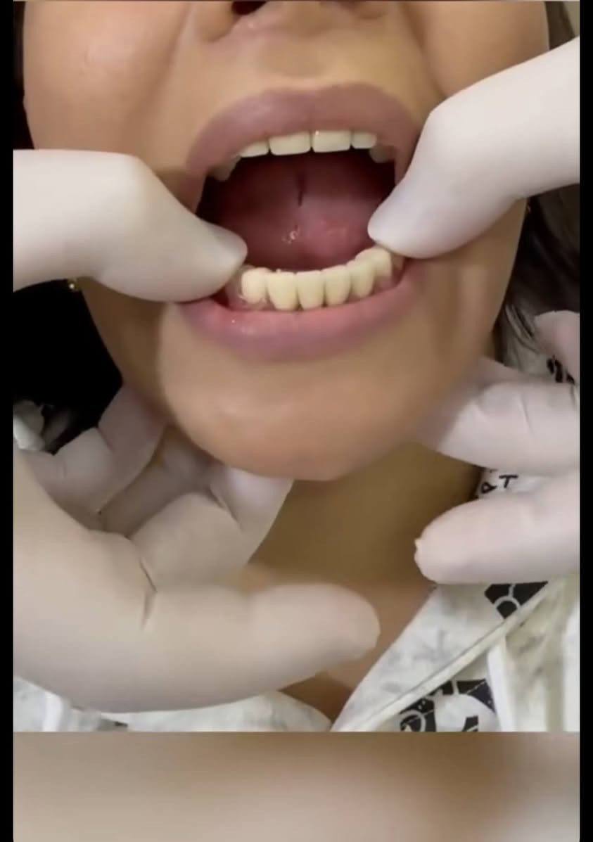 فاقد اسنانك وتريد تعوضهن؟!
بكلية طب الاسنان جامعة بابل نعوضهن الك بشكل مجاني 💸
كل الي عليك تنوي تحجز وتلتزم بالموعد 👍🏻📝
وخلال 4 جلسات راح يصير عندك طقم اسنان جاهز تلبسه بكل ايامك✨💓

احجز على الواتس ***********
او على ماسنجر الصفحة 🤝
الاربعاء ساعة 11 تنفتح العيادة
