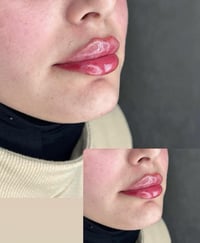 قسم التجميل اللاجراحي نستقبلكم في مركز الابتسامة التخصصي خلال شهر رمضا...