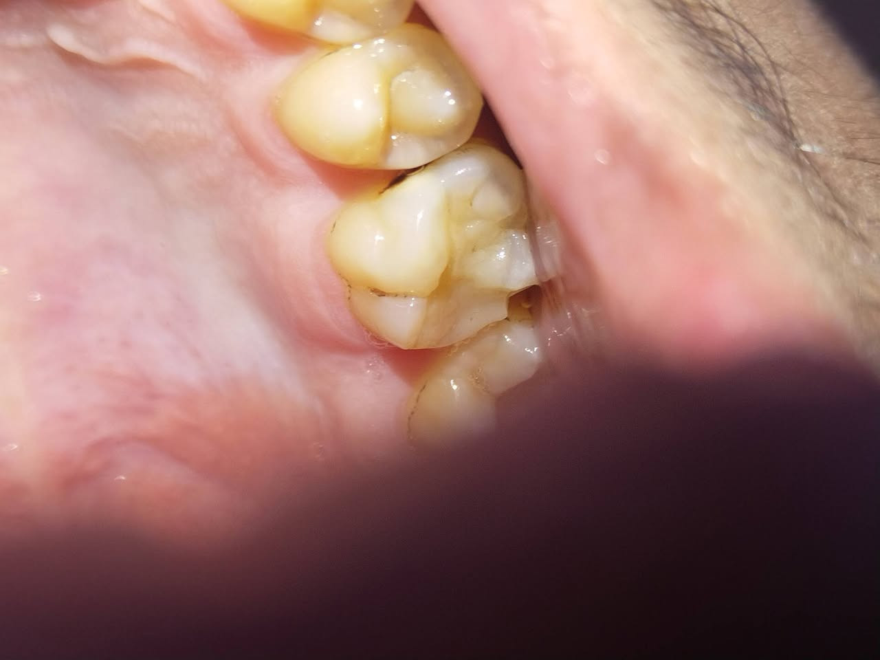 السلام عليكم

متوفر عدنا كافة علاجات الاسنان مثل
* الحشوه الضوئيه (التجميليه)
* تنظيف الاسنان وازالة التكلسات والتصبغات
* تعويض الاسنان المفقودة بطقم متحرك
* ازالة اسنان العقل
* ازالة الجذور التالفه(الي بقائها ممكن يسبب التهاب بالمكان او ممكن لتهيأة المساحه للزرعات المستقبليه)

🦷 العلاج مجاني وتحت اشراف كادر مختص
🦷 الموقع كلية الرشيد الجامعة

✨ زرعات الاسنان متوفره بس مو من ضمن العرض ومو بنفس الموقع اني بس اوصلكم للدكتور المناسب وبأسعار مناسبه للاستفسار عالخاص

🦷 *********** 
🦷 يوزر تيليغرام gagz_7
