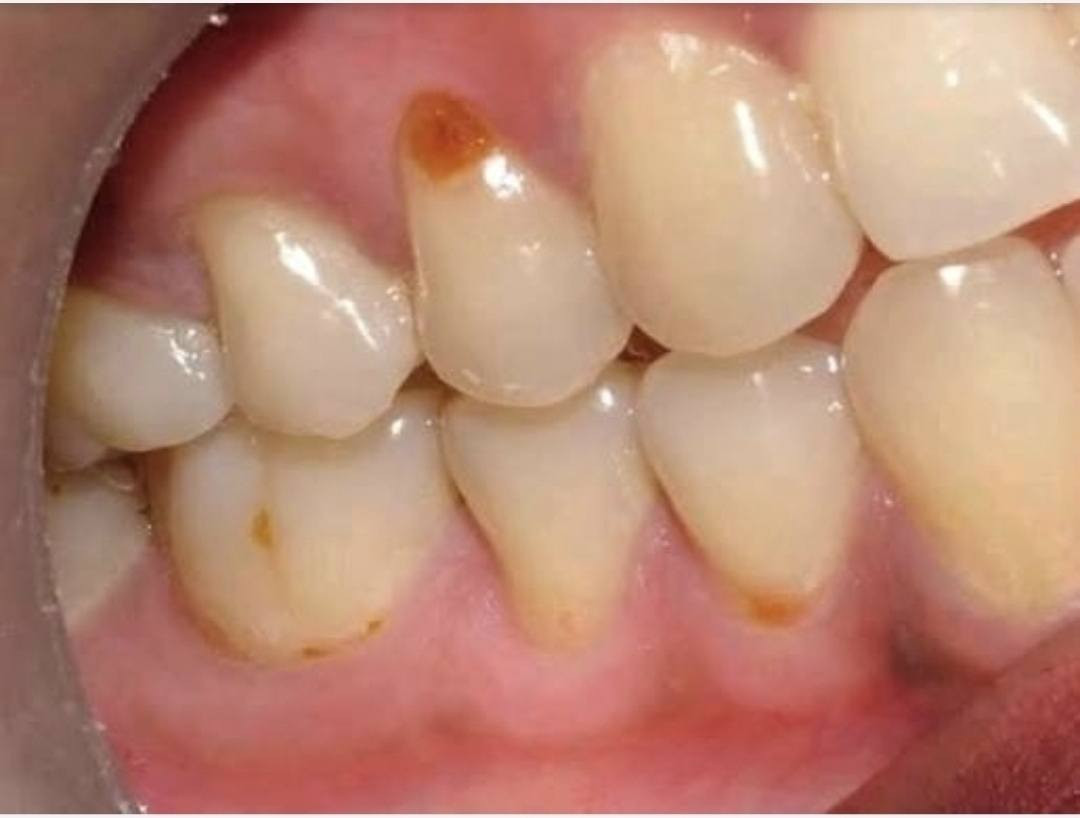 مجاناااااا
الي عنده هيج تسوس باسنانه مثل الي بالصورة ويريد يعالجه بحشوة ضوئية يتواصل ويايه خاص اويتصل على الرقم *********** والعلاج مجاناً
العنوان حلة شارع 40 مجاور صيدلية سلامتك
