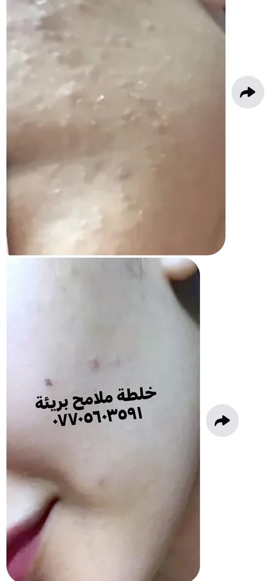 شمنتضرة ؟؟عالجي بشرتج 🥰
سارعي بالحجز 😘
وبرزي جمالج وملامحج الطبيعية ببشرة  خاليا من التصبغات والكلف والنمش والتجاعيد والحبوب وآثار الحبوب 🌹


**إذا كنت صاحب هذا الإعلان وتريد حذفه لأي سبب، رجاءا أرسل رسالة إلى الدعم الفني**