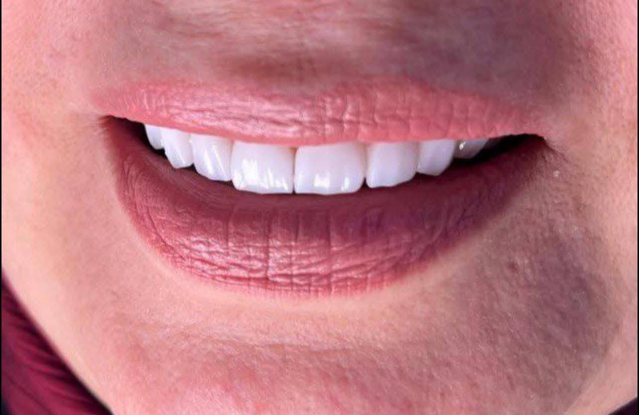 تم اعادة الابتسامة لمراجعتنا العزيزة
باغلاق فراغات الاسنان بتغليفات الزيركون
حاليا تخفيض على جميع أعمال العيادة
العنوان ميسان الماجدية شارع الملعب 
خلف مركز الشرطة امام جامع الثقلين
الدكتورة رويدة كاظم
للحجز والاستفسار 
*********** عمارة, ميسان
