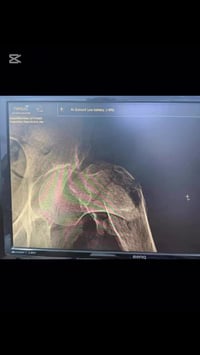 كسر مفصل الورك , اعلى عظم الفخذ بين المدورتين لمسنة في العقد السابع من...