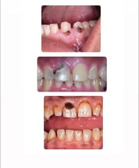 أي شخص عنده هيج تسوسات بأسنانه الاماميه او الخلفيه ويريد يعالجهن يراسل...