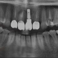 إذا جنت مأجل خطوة الزراعة ومتخوف من الألم أو الوقت، نحب نطمنك إن التقن...