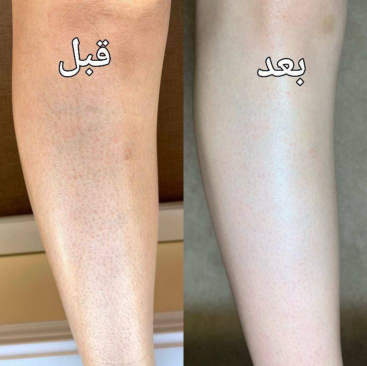 زواجج قرب وتردين تستغلين هاي الفتره وتخلصين من الشعر نهائيااا
ومتگدرين تروحين مراكز تجميل
وفرتلج الحل ليزر منزلي رهيييييب
بتقنية IPL 🌸
يخلصج من الشعر نهائياااا
وبدون اي اظرار ويكون باااارد 🥶
ابد ميحرگ المنطقه 
ويحتوي على 500الف ومضه يكفيج سنين
وسعرررررره صدمه 🔥ومنااااااسب للجمييييع 
وتوصيييييل مجاااااني لجميع محافظااات العراق 😍
#ليزر_منزلي


**إذا كنت صاحب هذا الإعلان وتريد حذفه لأي سبب، رجاءا أرسل رسالة إلى الدعم الفني**