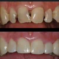 مرحبا منو محتاج تنظيف اسنان او قلع او عنده تسوس هيج؟ يتواصل ويايه جامع...