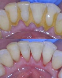 ✅مجانا مجانا مجانا✅ 🦷 هل تبحث عن:  • تنظيف الأسنان (ازالة التصبغات وال...