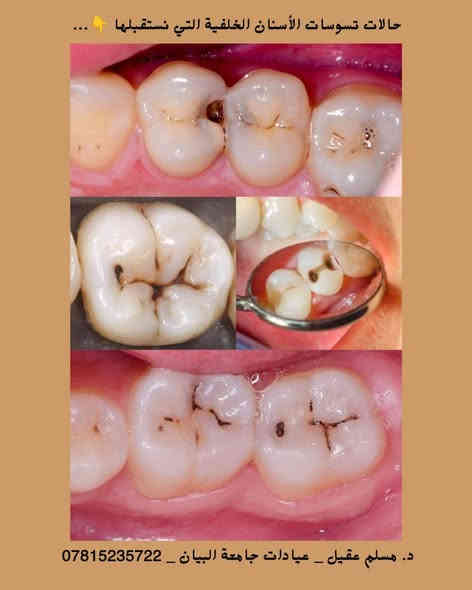 🔹️يسعدني استقبالكم في عيادات كلية طب الأسنان _ جامعة البيان _ شارع مطار بغداد الدولي – قرب ساحة عباس بن فرناس ...

🔹️العلاج بإشراف أساتذة مختصين وبعلاج مجاني بالكامل 💙🦷...

🔹️أسنانكم أمانة... وابتسامتكم مسؤوليتنا 💫
نقدّم رعاية شاملة لجميع الحالات، مع متابعة دقيقة لضمان أفضل النتائج...

🔹️الحالات التي نستقبلها :
• تنظيف وإزالة التكلسات والتصبغات.
• فحص شامل للأسنان وتقييم اللثة.
• إزالة التسوسات وحشوات ضوئية وبلاتينية.
• قلع الأسنان الأمامية والخلفية والجذور التالفة.
• عمل أطقم جزئية متحركة لتعويض الأسنان المفقودة.
• متابعة دورية للحالات لضمان استقرار النتائج.

🔹️للحجز والاستفسار 📩:
• واتساب: ***********
• إنستغرام: dent.muslim1
• تلغرام: @Dr_Muslim45

#العراق #بغداد #عيادات_جامعة_البيان #ابتسامتك_مسؤوليتنا #تنظيف_أسنان #حشوات_ضوئية #ابتسامة_صحية #مجاني #Baghdad #Iraq #طب_الأسنان #DentalCare #Smile #TeethCleaning #عيادات_مجانية #اكسبلورر #لايك
