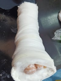 اليوم زارتنا المريضة وعدها كسر في السلامية الإصبع الوسط وتم تجبيسه وال...