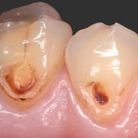 الي عنده اسنان مسوسه مثل الي بالصوره يتواصل ويانه على هذه الرقم ٠٧٨٧٥٢...