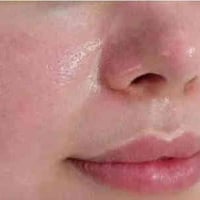 تنضيف بشره • جلسة نضارة • حجز خميس جمعه