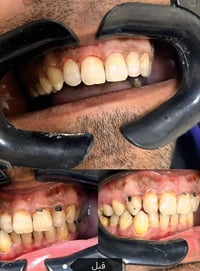 حشوات تجميلية • اليمامه التخصصي • ساعات ٤-٨م