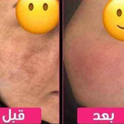 خلطه وصابونه 
شرط الشغل بلعباس  مجربه ومضمونه خلال 3 ايام تبين النتيجه وحق العباس 
عندك سمار تبيض الوجه تصفيه من الحب والكلف والنمش والتصبغات والسواد الجوه العين 
اثار حبوب اثار الشمس أخذي وخطيتج بركبتي شغله رهيييييييييييييييييب
والي مجربيها قبل يعرفون معنى كلامي المنتج الاول لعلاج وإزالة الكلف والبقع 
تعالج الكلف والبقع وترطب البشره وينطيها نضاره وبنفس الوقت تفتيح وتبييض  للبشره للاستفسار وات ساب 
 ***********
*********** عمارة, ميسان
