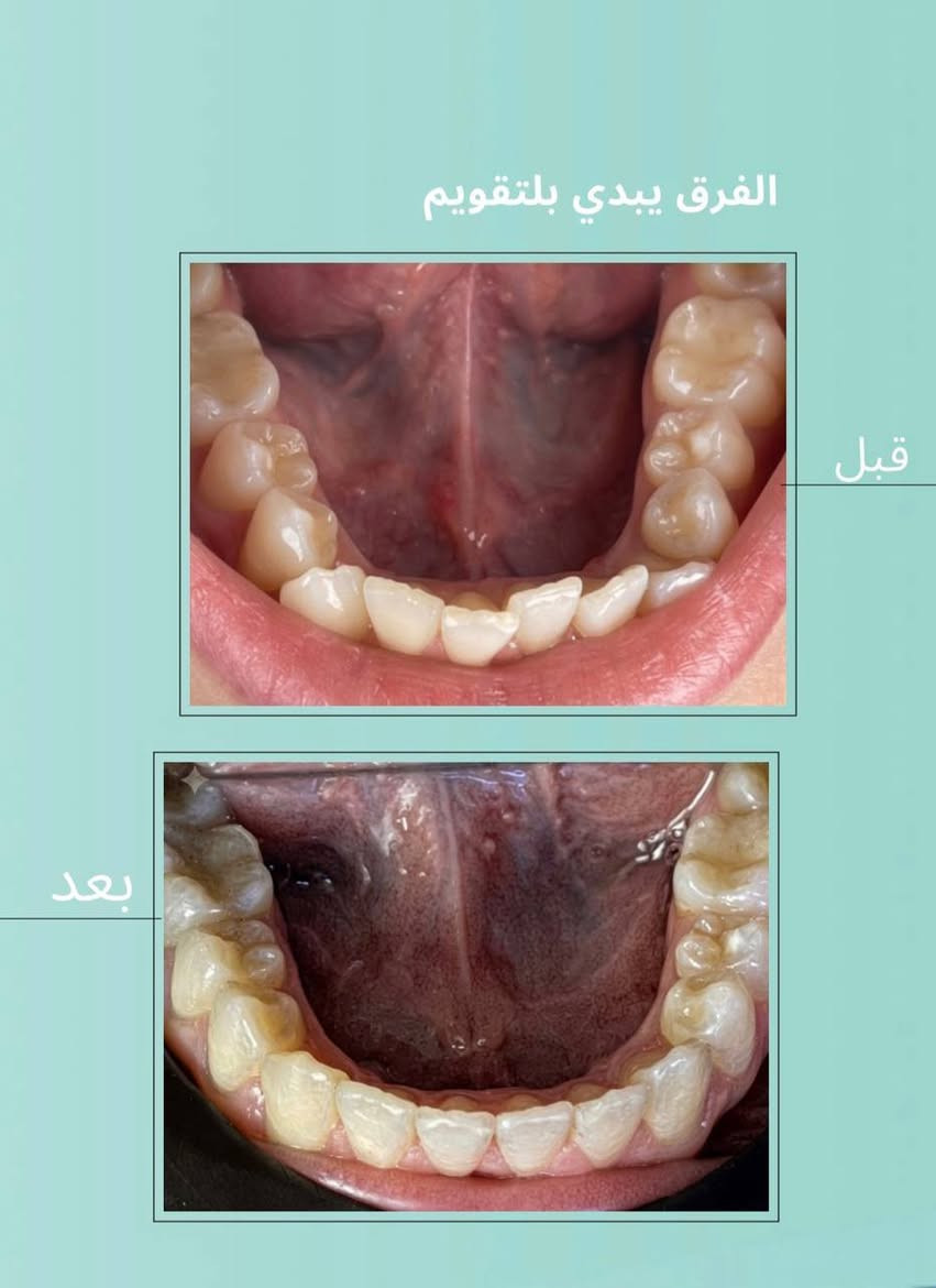 من أول زيارة إلى آخر موعد… كانت النتيجة ابتسامة تستحق كل خطوة ونشارككم إحدى رحلات التقويم الناجحة التي انتهت بنتيجة مميزة.

بإشراف الدكتورة آية عاصم

متواجدين يومياً من الساعة ٤ العصر وحتى الساعة ٩ مساء 

عيادة الإتقان لزراعة وتقويم الأسنان 

نستقبلكم بكل حب يومياً

للحجز والأستفسار الاتصال
***********

الطوبچي / مقابيل كوكتيل البركة، بداخل فرع صيدلية الابتغاء

#بغداد #عيادة_اسنان #عيادة_الإتقان⁩⁩⁩⁩⁩⁩⁩
