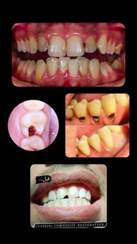 تسوسات اسنان • ماسنجر • واتساب
