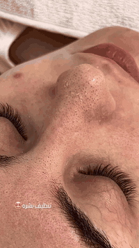 جلسه تنضيف بشره هيدروفيشيال 🤍🔥
فوائد تنضيف البشره :

✅-إعادة النضارة للبشرة الباهتة وتحسين ملمس البشرة.
✅-تقليل إفراز الزيوت في البشرة الدهنية 
✅-تخليص البشرة من الرؤوس السوداء والبيضاء.
✅-تحفيز الكولاجين الذي يعطي نتائج فورية.

العنوان الخاجيه شارع 40 داخل السوق لعصري 🌲 حبايبي اسم مالتنه نونه اكرلك ماعدنه غير فرع
***********
