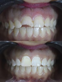 مستفيدا من عروض عيادة البيت الطبي📍📍 مراجعنا العزيز عمل حشوه ضوئيه بجلس...