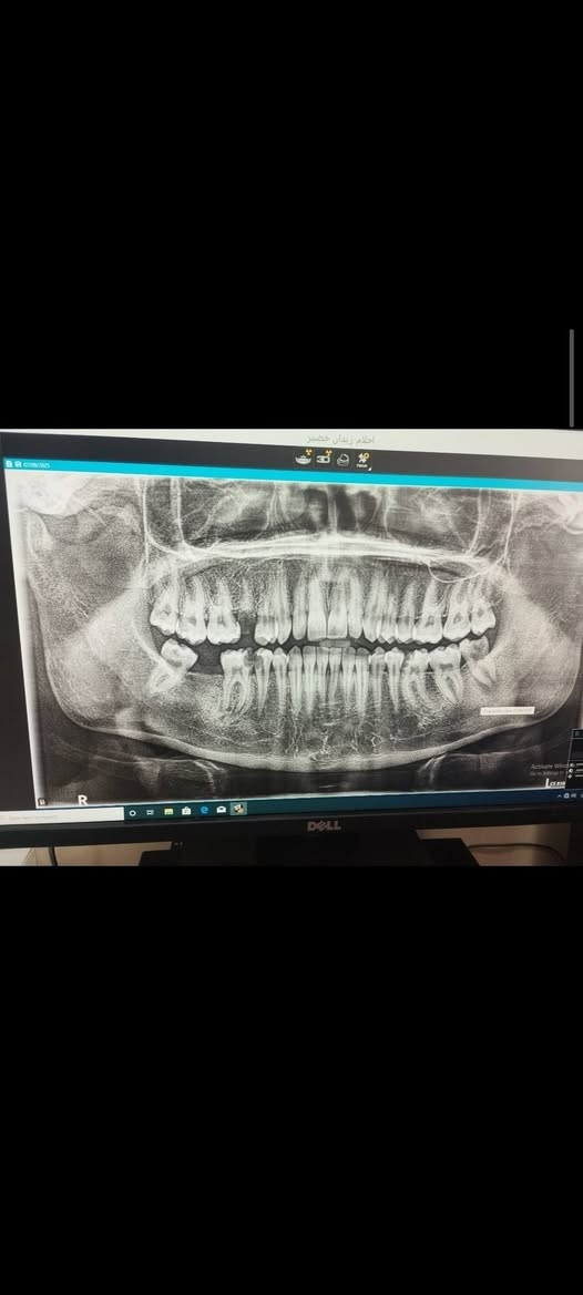 علاج مجاني
السلام عليكم ورحمة الله وبركاته للمرضى الاعزاء يتوفر لدينا :-

قلع سن.

 حشوة اعتيادية.

 تنظيف الاسنان من التكلسات.

تبديل حشوة قديمة بحشوة ضوئية.

طقم اسنان للفكين الاسفل و الاعلى.

مجاني في  عيادات جامعة النور التخصصية لطب الاسنان بإشراف الدكاترة المتخصصين في طب الاسنان الاستفسارات والأسئلة العامة الاتصال على الرقم التالي :
***********
الدكتور واثق عبدالله حسن 
ابتسم وانت مرتاح
