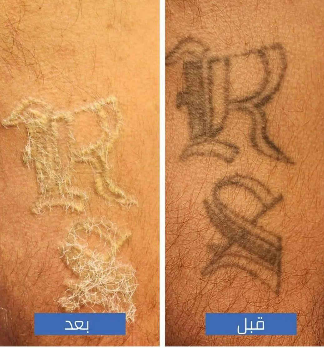 مستعدون لازالة جميع انواع الوشوم القديمة والحديثة بآحدث الأجهزة 
البصرة الجمهورية شارع الاطفاء مقابل ريتاج سنتر قرب حسينية البتول عليها السلام 
*********** البصرة, العراق
