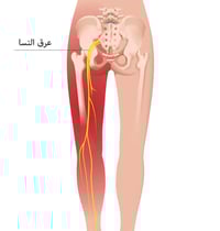 حجامة عرق النسا • أبو غريب • كادر مختص