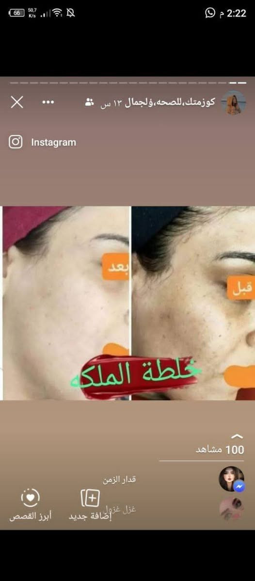 خلطه سن شاين♥♥الاصليه♥♥
معجزة التبيض الضمان حقيقي للمنتج
نتائج واضحة بعد 3 ايام من الاستعمال😲😲😲

 ((مع ابرة النضاره الملكيه)) 

🌹 فوائد الخلطه👇🏻👇🏻👇🏻
1-التبيض 7 درجات. 
2-ازالة التصبغات.
3-ازالة الكلف و النمش.
4-ازالة التجاعيد(ان وجدت).
5-ازالة هالات السوداء تحت العين.
6-تضيق المسامات.
7-ازالة حب الشباب و اثار الحب. 
8-امن للبشرة الحساسة و مناسب لجميع البشرات الدهنية و وجافه
للحجز والاستفسار واتساب رقم تلفون ***********
