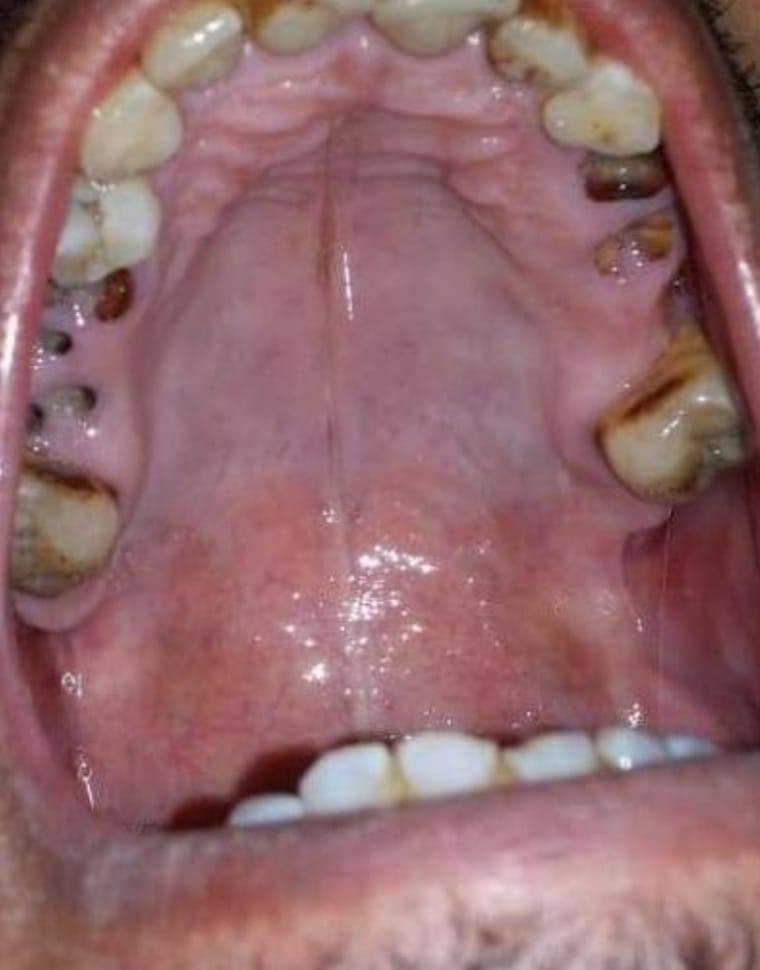اذا عندكم مثل الحالة بالصور
بقايا اسنان تالفة او اسنان تتحرك 
تتواصلون ويانة على هذا الرقم:  ***********

قلع مجاني وبإشراف اطباء اختصاص

