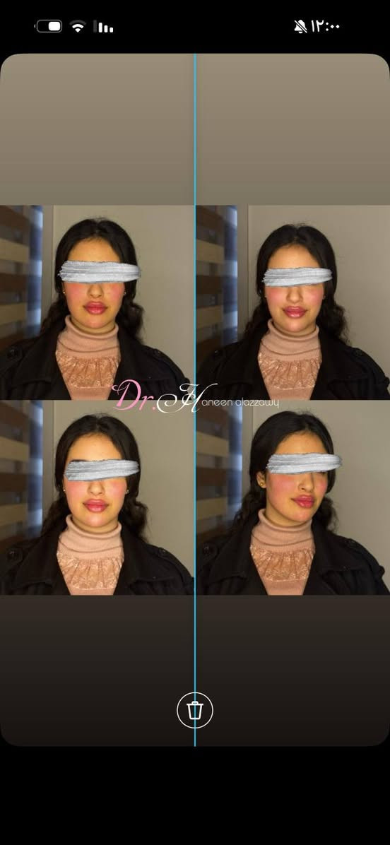 ♥️عيد الحب♥️ ويانه غير (لكل جميلات بغداد) هالعيد دللي نفسج بهدية جمال مميزة🎁
عروض الحقن والفلر الخاصة بعيد الحب
العرض لمدة محدودة ،لا تفوتي الفرصه
العنوان :عيادات خبراء الطب التخصصي /مقابل كراج الاسدي.               ***********📞
#تجميل ـ بغداد#فلر#حقن ـ تجميلية - #جمال - طبيعي#عيد الحب  # عروض #ستايل- عراقي
 للاستفسار و الحجز⏪Haneen Alazzawy
