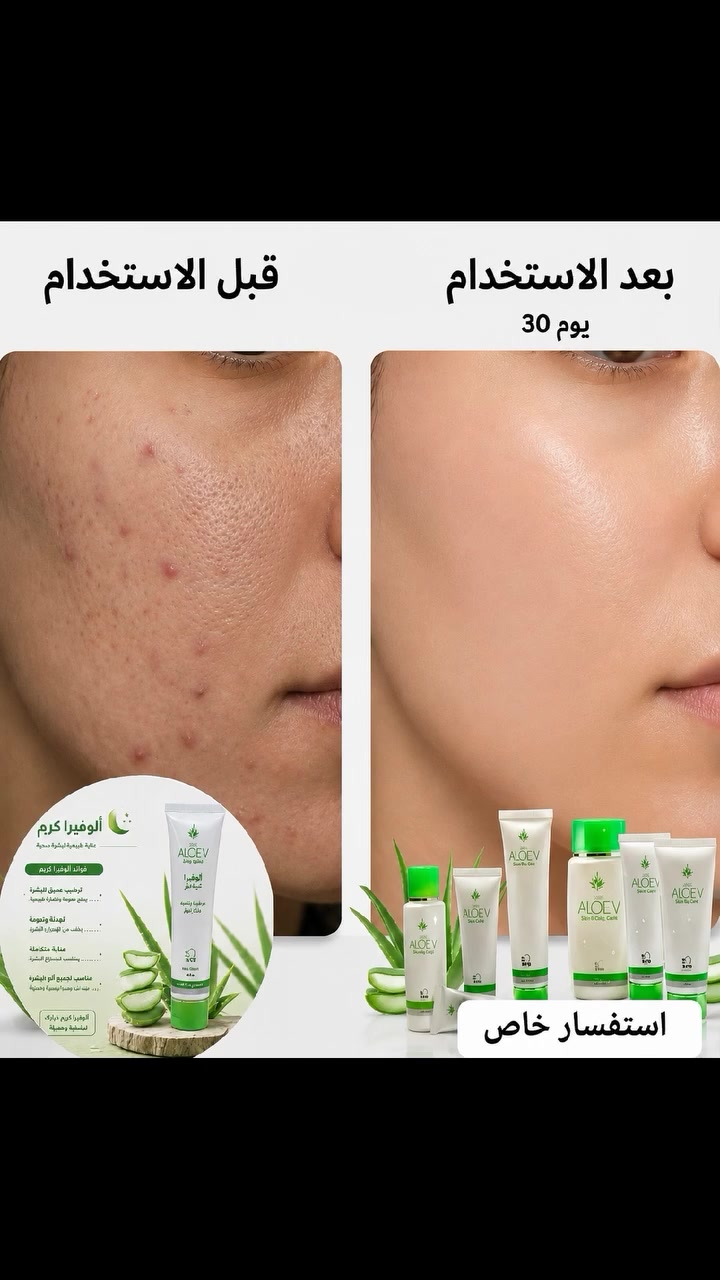 شوفي الفرق بعينچ 👀
30 يوم بس مع كريم #ألوفيرا ALOEV ✨

قبل الاستخدام: حبوب + آثار + مسامات 
بعد 30 يوم: بشرة صافية موحدة بدون فلتر

النت يجة تحچي، مو أنا 🙏

للاستفسار والحجز راسليني خاص 📩
التوصيل لكل #محافظات_العراق  🚚


**إذا كنت صاحب هذا الإعلان وتريد حذفه لأي سبب، رجاءا أرسل رسالة إلى الدعم الفني**
