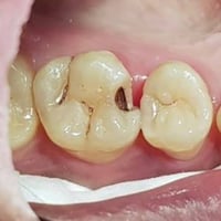 علاج مجاني • حشوة أسنان • عيادات جامعة واسط