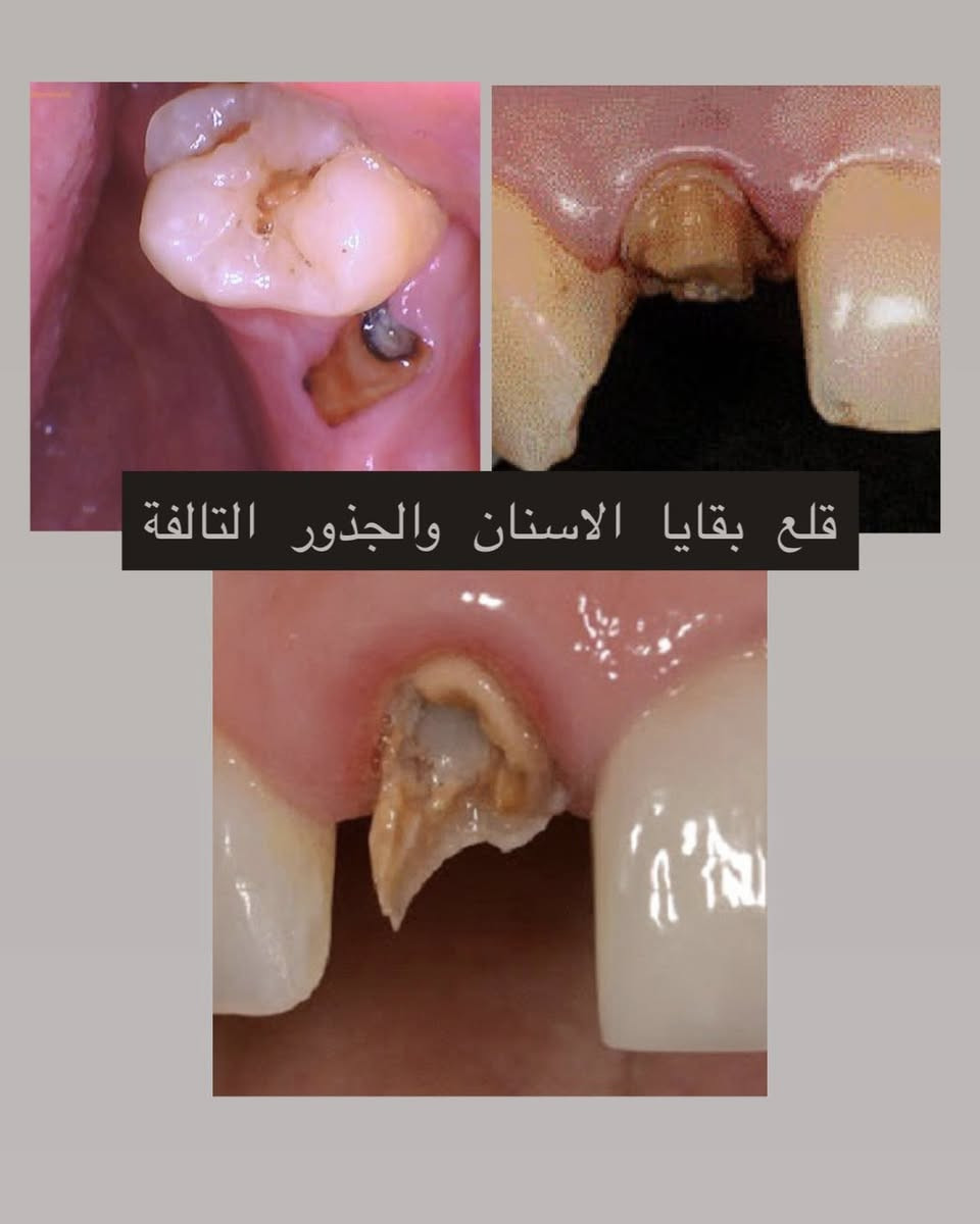 تبحث عن علاج مجاني وآمن؟✨
نلتقيكم في عياداتنا!
📅 بدأنا نستقبل الحالات في عيادات جامعة كركوك !

🔹 الخدمات المتوفرة:
 •قلع الأسنان
 •الحشوات
 •تنظيف الأسنان
 •أطقم الأسنان

سارعوا بالحجز، الحجوزات محدودة !

💌 للحجز والتفاصيل: مراسلة الصفحة او التواصل على الرقم ***********
