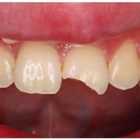 الي عنده كسر باسنانه الاماميه يتواصل ويايه علاج مجاني 07802888723