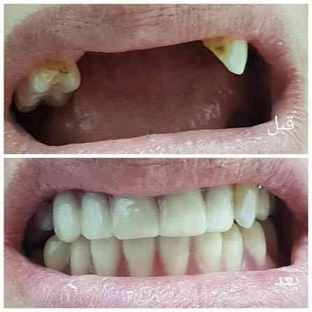 العلاج #مجاني لفترة محدودة
تعلن عيادات طب الاسنان في جامعة الكوفة عن استقبال المراجعين الذين يعانون من :
1- تكلسات وتصبغات الأسنان (تنظيف الأسنان) 
2-قلع الاسنان التالفة وبقايا الجذور
3- ازالة جميع التسوسات وعمل حشوات تجميلة
4- تعويض الأسنان المفقودة بطقم جزئي متحرك
للأستفسار اكثر مراسلة صفحتنا 
او عن طريق الواتساب ***********

#صحة #اسنان #مجاني #اهتمام #رخيص
