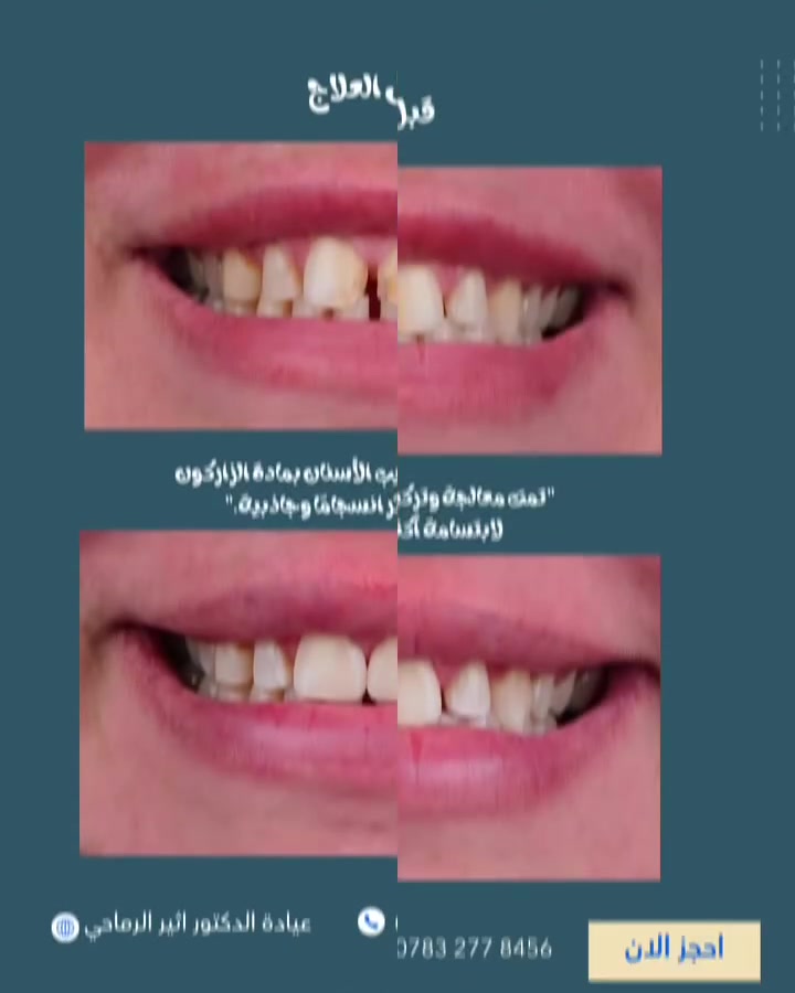 بتركيبات الزاركون ، تعود الابتسامة بتفاصيل أجمل ولمسة أكثر فخامة.”😌😍

 (عيادة الدكتور أثير حليم الرماحي)

☎️ للحجز والاستفسار ***********
او مراسلة الصفحة

📍 لموقع: 
الديوانية- قضاء عفك/شارع الأطباء قرب صيدلية أكرم البديري بناية الدكتورة مروة حمود التميمي الطابق الثاني

#ابتسامتك_تستحق_الأفضل
#دکتور_اسنان #تركيب_زاركون
#اكسبلورexplore #قضاء_عفك
