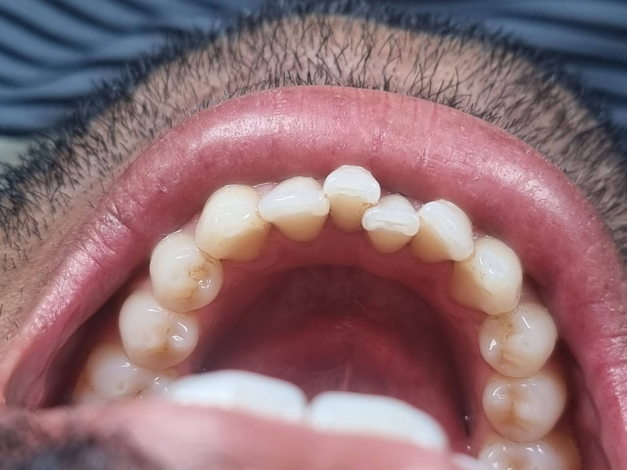 من الاعمال اليوميه لعيادتنا
#عيادة_كوثى_لطب_وتجميل_الاسنان 

تنظيف الاسنان لاحد مراجعينا💫
التخلص من التصبغات الجيريه على طبقة المينا
ومنضر الاسنان 
ليتحول  منظر الاسنان الى لامع ناصع البياض
#الدكتور_علي_حسن_العزاوي

يتوفر العمل بالتقسيط المريح على زراعة وتغليف الاسنان

بابل/جبله/نهاية شارع الاطباء (مقابل مجمع الدكتوره ميثاق المعموري )
للاستفسار
***********
