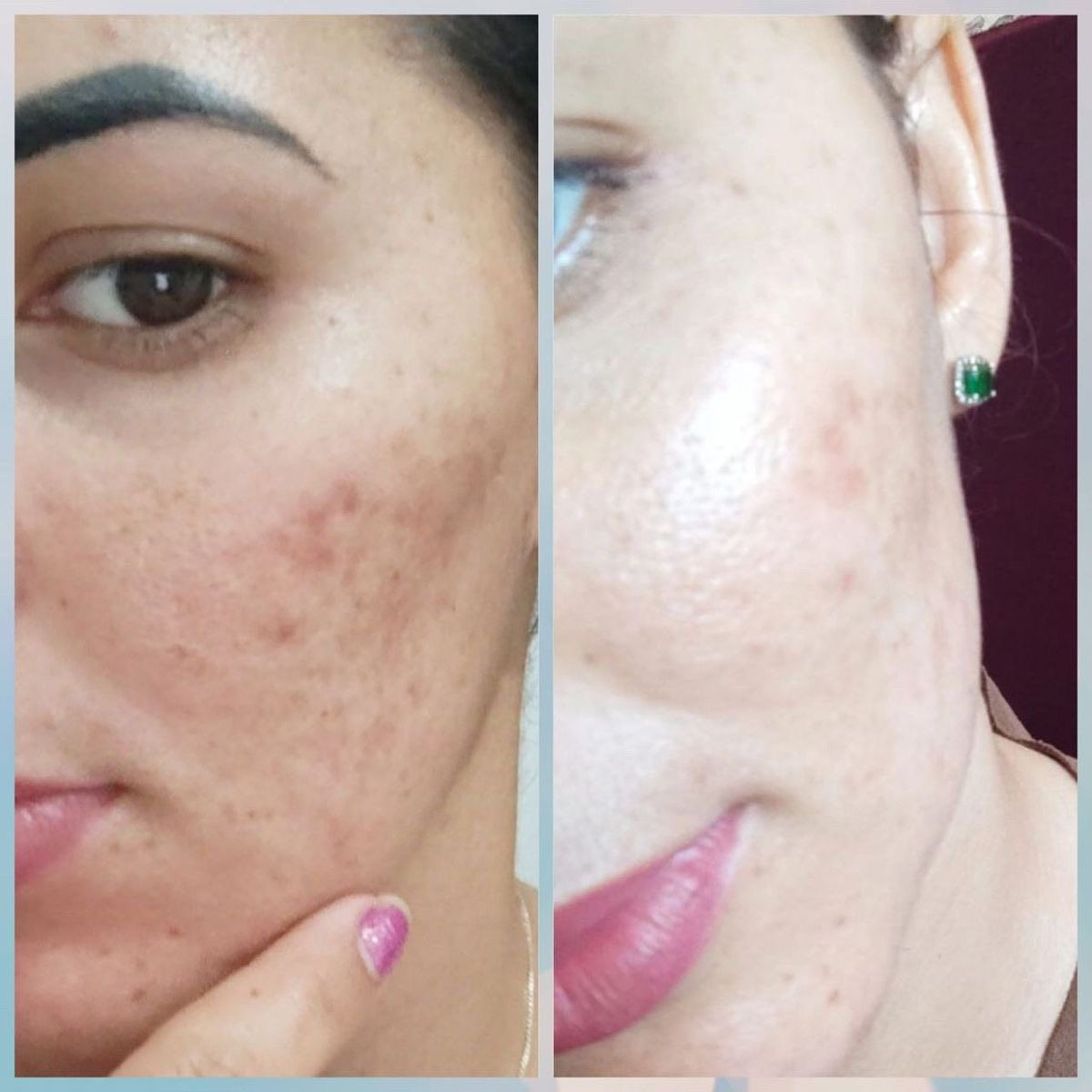 اقسم بالله العلي العظيم خلطه مجربه ومظمونه
فوائد الخلطه مع الصابونة :
1- تفتيح وتوحيد لون البشرة 
2- إزالة التصبغات و البقع السوداء
3-  تضييق المسام وتنعيم البشرة
4-  يقضي على النمش والكلف 
5- تبيض البشرة من 5 الى 7 درجة
6-ازالة حب الشباب وآثاره
  
اظافه الئ 👇

مسمن مورد ينطي امتلاء للوجه مع تبيض وتوريد شغله كلش روعه حرفيا ايجنن اضافه الئ صابونه مسمنه مورده تستخدم للوجه  وايضا تستخدم للمناطق الحساسه رووووعه 👌
واتساب ***********
