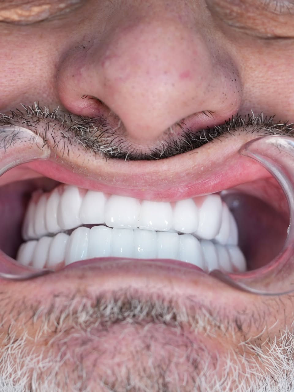 حالة زراعة فك كامل بزرعات فورية وتلبيس الاسنان الزاركون العنوان : المنصور : الاميرات - مقابل مطعم ست الشام. ***********
