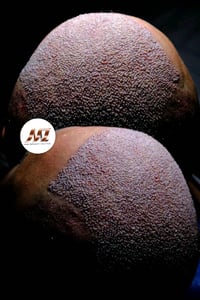 زراعة شعر • ضمان مدى الحياة • اربيل
