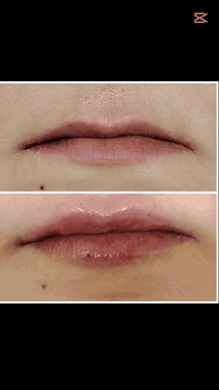 فيلر شفه 1سيسي • بعقوبة-التحرير • عيادة دكتورة ميس