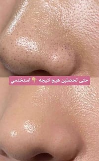 لاصقات أنف • شجرة الشاي • إزالة الرؤوس السوداء