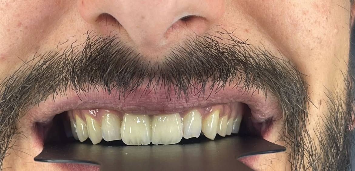 🔥 عرض ابتسامة زاركون لهذا الاسبوع
برد بسيط + شغل مختبر احترافي
لون وشكل حسب اختيارك
نتيجة طبيعية وثابتة

عيادة الدكتورة هند الحسيني 
***********
الامين الثانيه/شارع المهداوي /فوق صيدلية غزوان باسم
