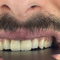 🔥 عرض ابتسامة زاركون لهذا الاسبوع برد بسيط + شغل مختبر احترافي لون وشك...