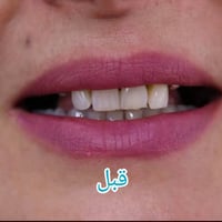 زراعة أسنان • زرعات ألمانية • ضمان مدى الحياة