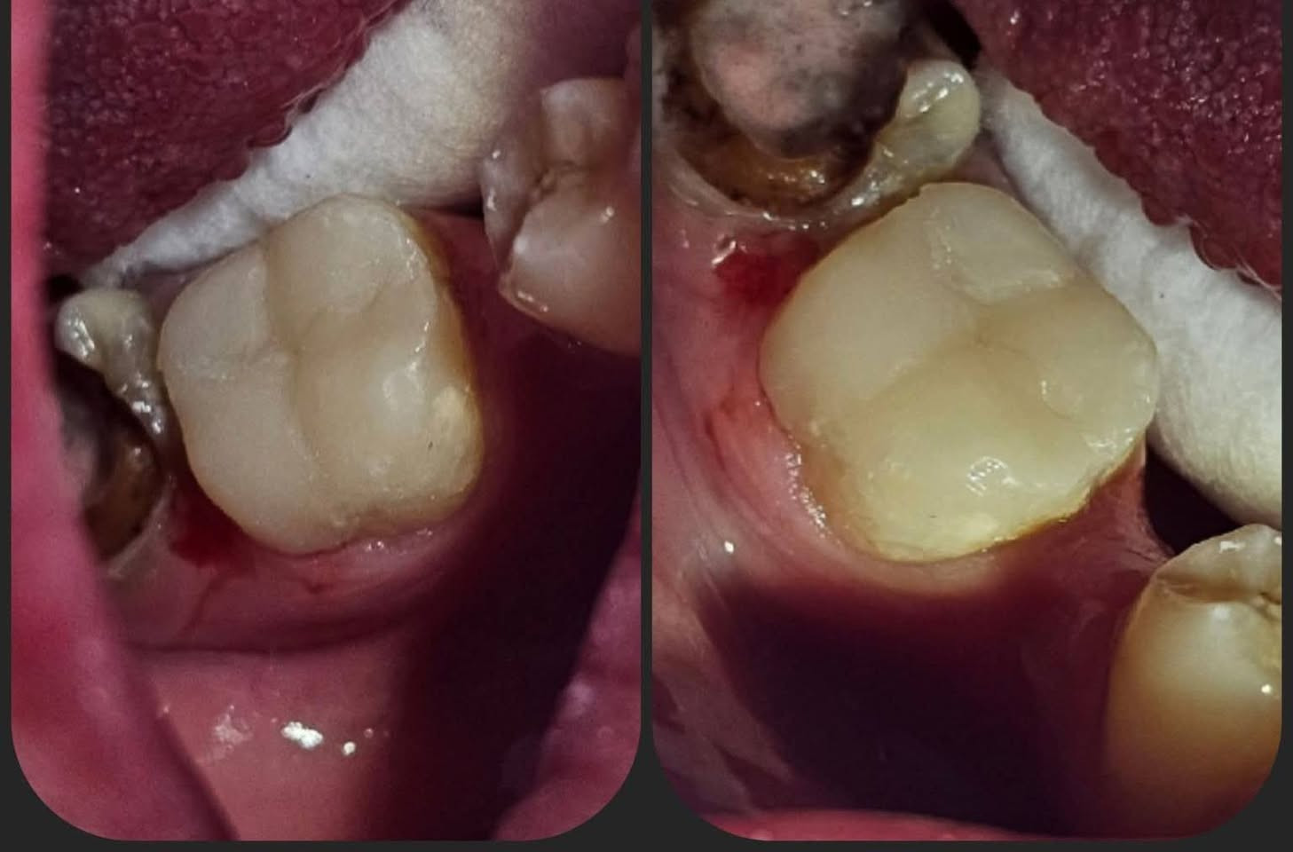 مركز أبو سيفين للاسنان 🦷 Abo Sefen El Nozha 

🦷 حشو العصب مش حاجة تخوف... لكنه وسيلة لإنقاذ سنّك!
لو بتعاني من ألم شديد، أو حساسية مستمرة، أو وجع بيزيد بالليل، فقد تكون محتاج حشو عصب.
✅ يزيل الألم. ✅ يحافظ على الضرس بدل خلعه. ✅ يرجعلك القدرة على الأكل براحة.
كل ما بدأت العلاج بدري، كانت النتيجة أفضل والعلاج أسهل.

مركز أبو سيفين للاسنان 🦷 Abo Sefen El Nozha 

مواعيد العمل فرع القاهره 
 🔹 صباحًا: الجمعة والسبت من الساعة ١ ظهرًا
🔹 مساءً: يوميًا من الساعة ٧ مساءً
📲 الحجز الحجز نفس اليوم عن طريق واتساب من الساعة ١٠ صباحا حتى الساعة ١٢ ظهرًا
📞 ٠١١٠١٧٤٢٤٢٣

مركز أبو سيفين للاسنان 🦷 Abo Sefen El Nozha 

 احنا موجودين دايما عشان ابتسامتك وراحه اسنانك وحياه افضل بدون الم 🌹😍

   عنوانا 👇
فرع القاهره
🏠 شارع الخمسين أعلى محل الملكه للمفروشات ومحل رهف للعطور بجوار هايبر النسر الخمسين الدور الاول مركز أبو سيفين للاسنان 

☎️ التواصل واتس // 01101742423
0221932424

فرع المنيا
🏠 شارع الحريه بجوار المطرانية - ديرمواس
☎ 01229238060
#د_بيشوي_القمص #د_ابانوب_القمص #د_ماري_ايمن


**إذا كنت صاحب هذا الإعلان وتريد حذفه لأي سبب، رجاءا أرسل رسالة إلى الدعم الفني**