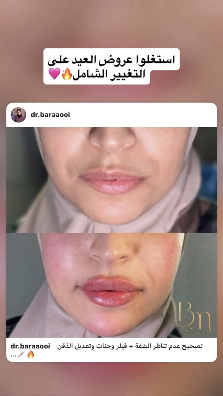 استغلوا عروض العيد من عيادة اوليفيا للتجميل
العنوان : الجريخي مجمع الصدرين الطبي الطابق الثاني 
٠***********
