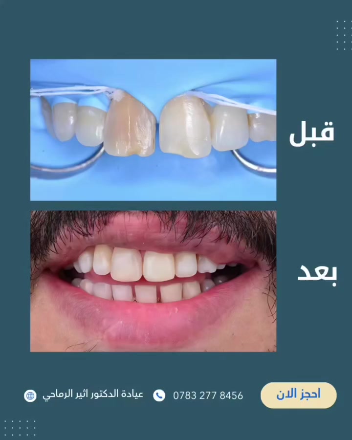 إعادة بناء وتجميل الأسنان الأمامية بحشوة تجميلية.. ابتسامة طبيعية ومتناسقة "

(عيادة الدكتور أثير حليم الرماحي)

للحجز والاستفسار ***********
او مراسلة الصفحة 

📍الموقع: 
الديوانية- قضاء عفك/شارع الأطباء قرب صيدلية أكرم البديري بناية الدكتورة مروة حمود التميمي الطابق الثاني

​#دكتور_أثير_الرماحي #تجميل_الأسنان #حشوات_تجميلية #طب_أسنان_العراق #قبل_وبعد.
